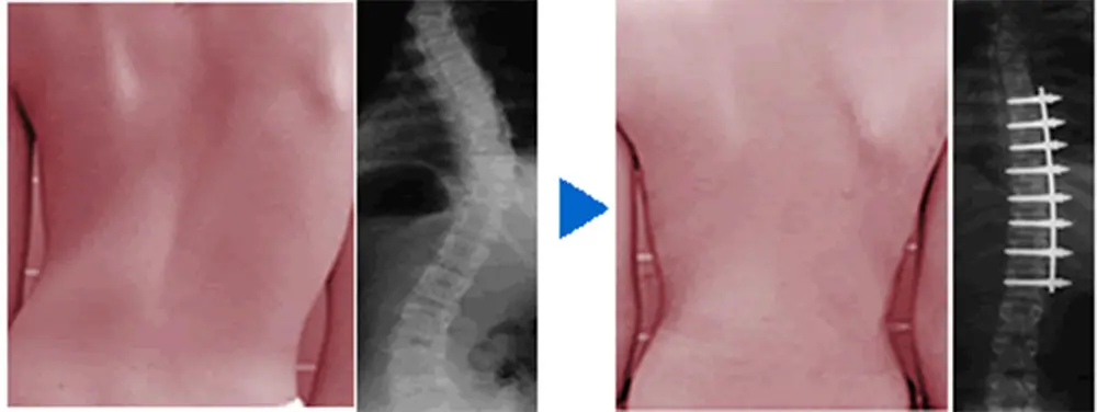 〔図6〕特発性側彎症に対する小切開手術、術前・術後
