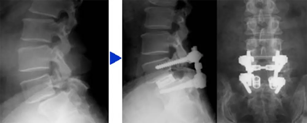 腰椎すべり症に対する除圧ならびにインストゥルメンテーション手術を用いた脊椎固定術