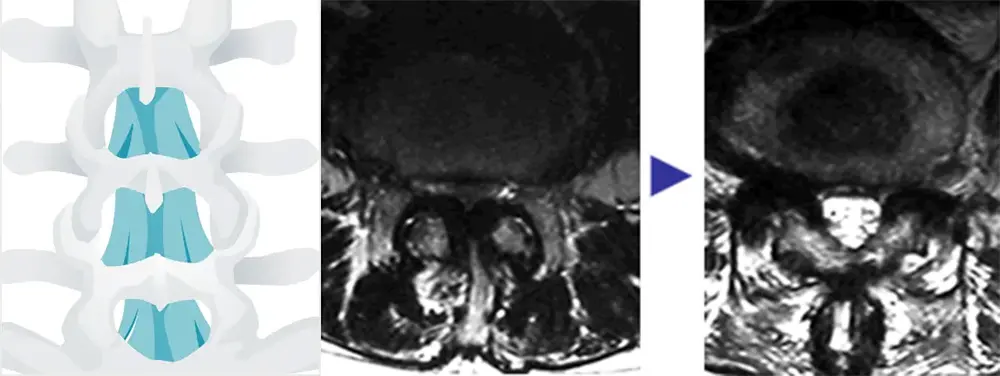 〔図1〕椎弓形成術、変形性脊椎症による腰部脊柱管狭窄における神経への圧迫の除圧